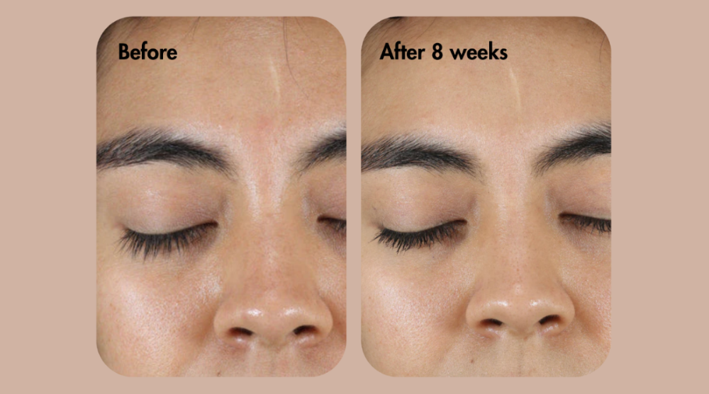 Vergelijking voor en na van een wenkbrauwbehandeling op het gezicht van een persoon.